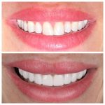 patient smile transformation