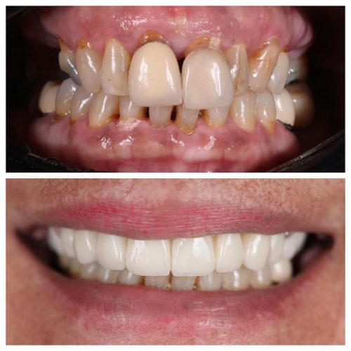 smile-transformation-with-cosmetic-treatment