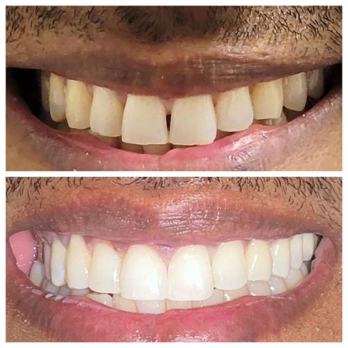 teeth whitening transformation