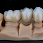 dental bridge