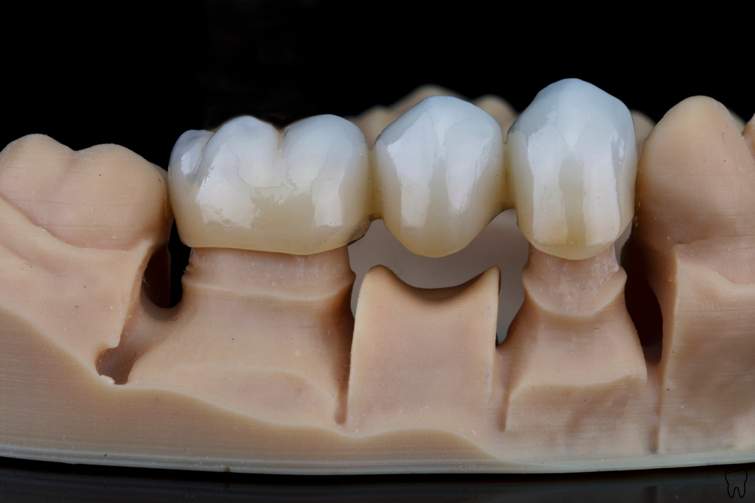 dental bridge