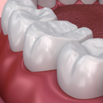 dental filling